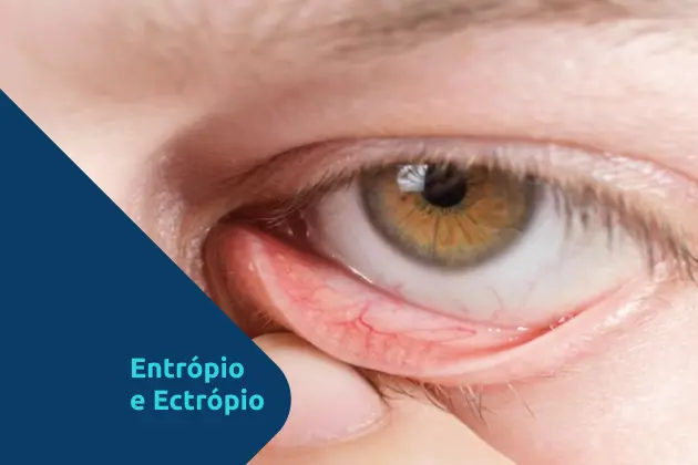 Ectrópio e entrópio