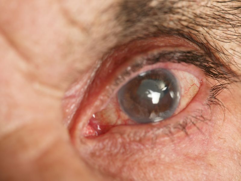 Glaucoma